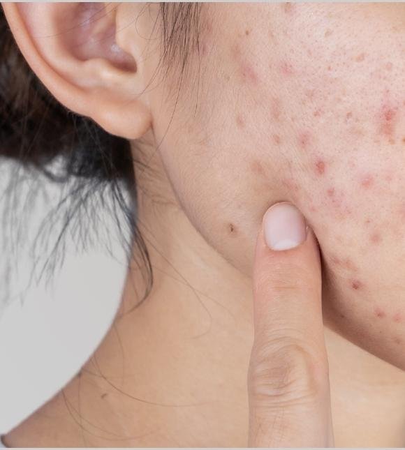 Acne Scars