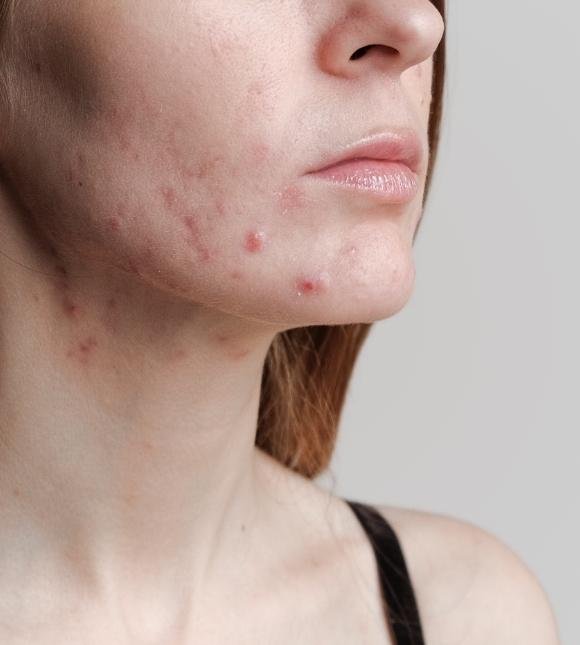 Active Acne Skin