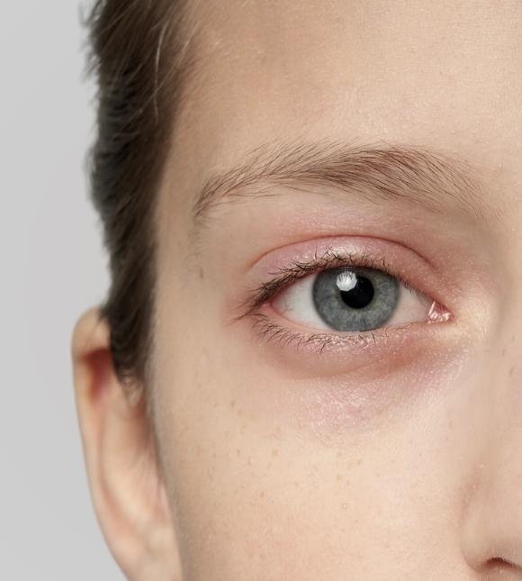 Eyebags Dark Circles