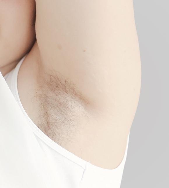 Hair Loss