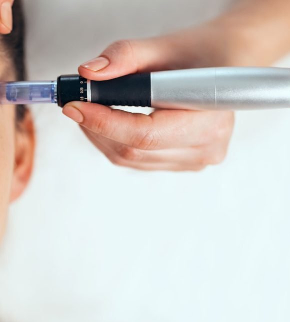 Microneedling