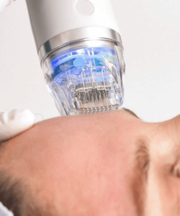 Potenza RF Microneedling