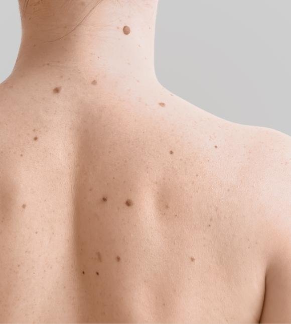 Skin Tags and Moles