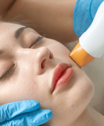 Thermage Skin Lifting