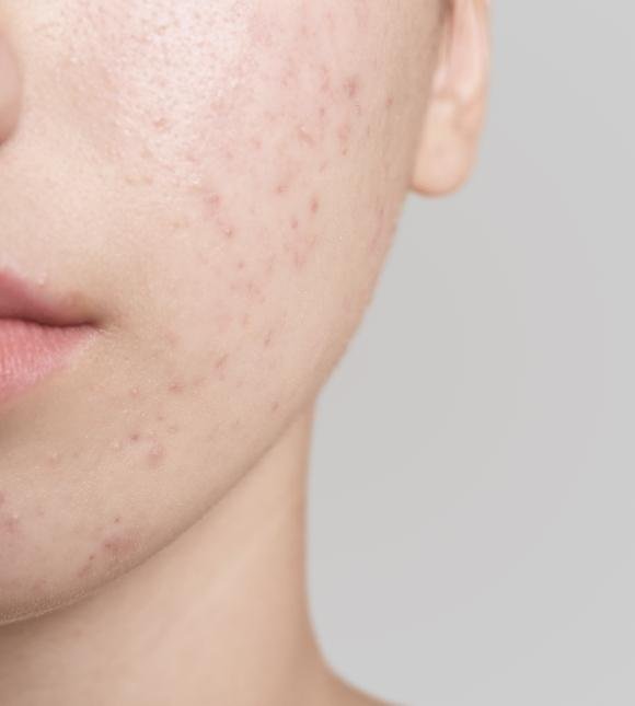 Uneven Skin Tone