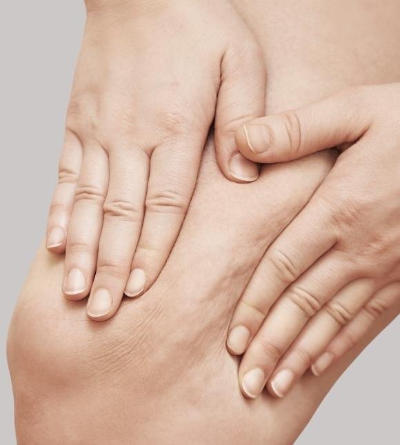 cellulite