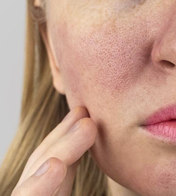 enlarged pores