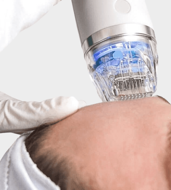 potenza microneedling