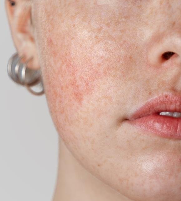 rosacea