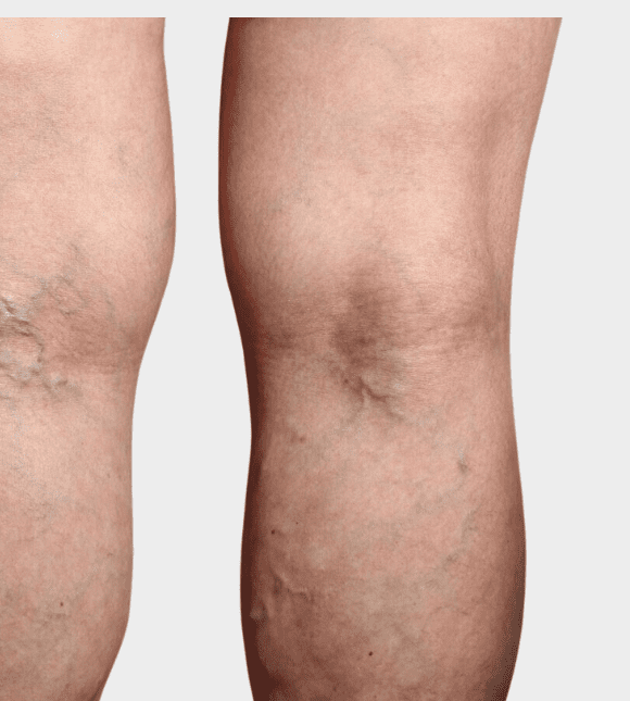 spider vein