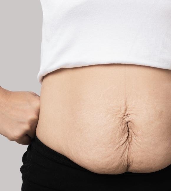 stretch marks