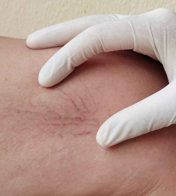 signature cosmetic clinic vascular removal treatment
