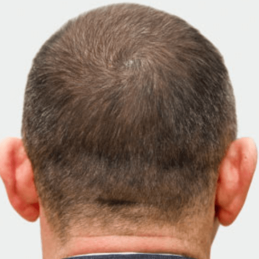 alopecia after 1