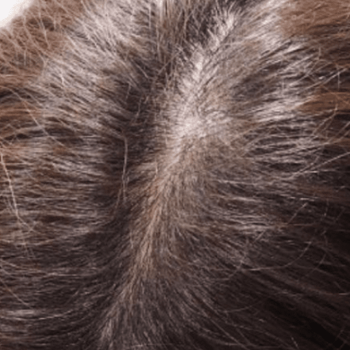 alopecia after 2
