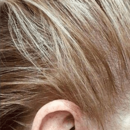 alopecia after 3