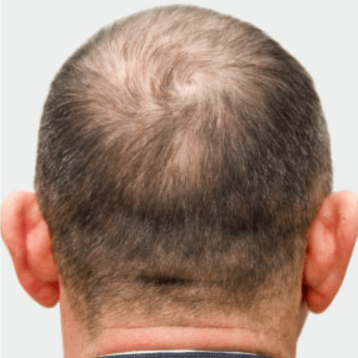 alopecia before 1