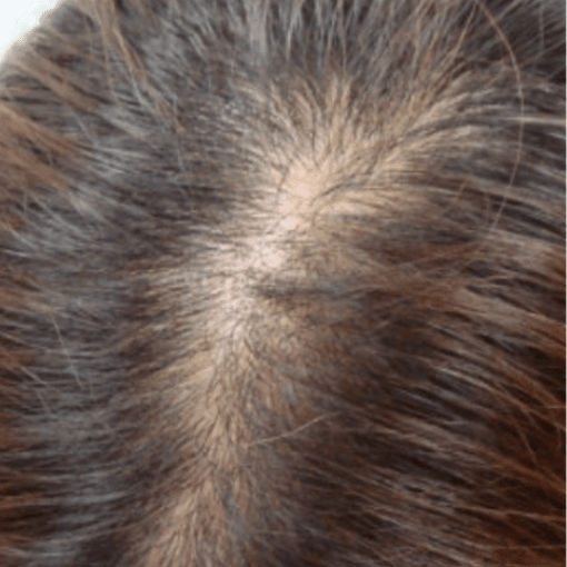 alopecia before 2