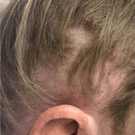 alopecia before 3