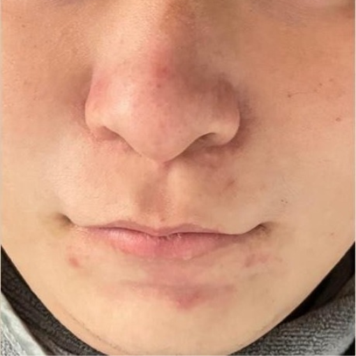 Aqua Peel after 1 1