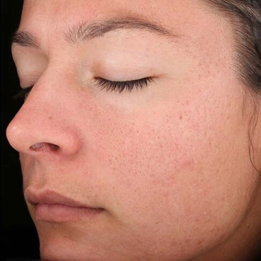 Chemical Peel after 1