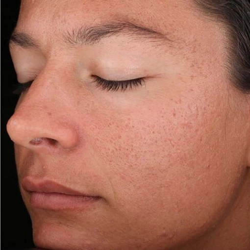 Chemical Peel before 1