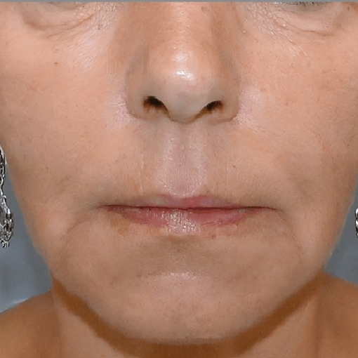 Derma Filler After 3