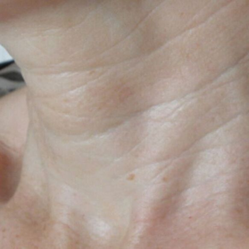 EndyMed Skin Tightening after 1