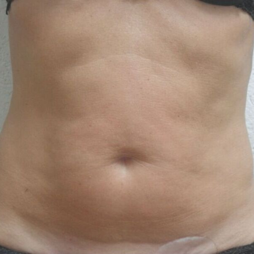 EndyMed Skin Tightening after 2