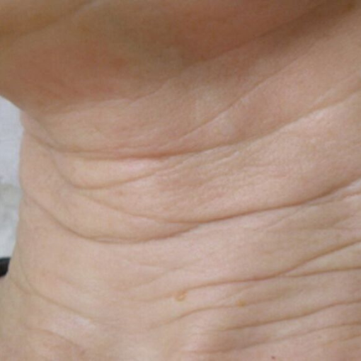 EndyMed Skin Tightening before 1