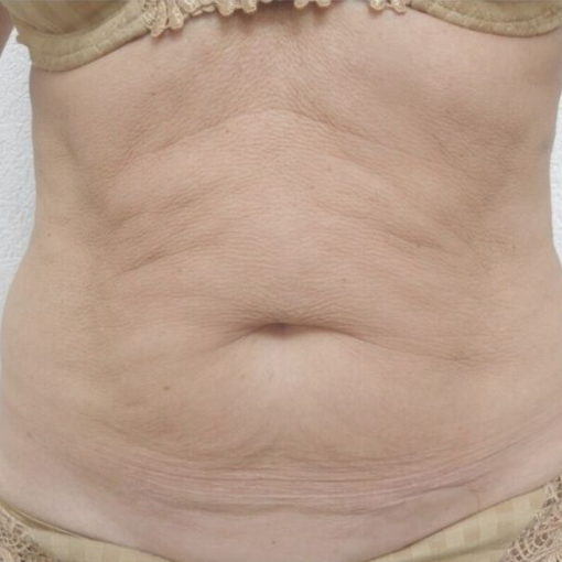 EndyMed Skin Tightening before 2