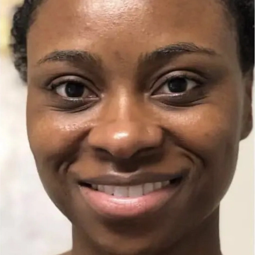 HydraFacial MD after 2