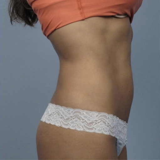 InMode BodyFX After 1