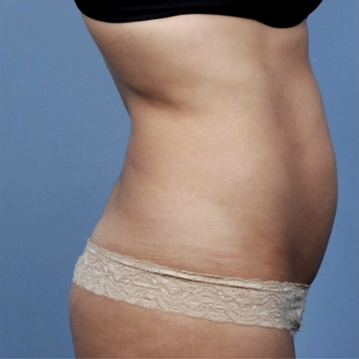 InMode BodyFX Before 1