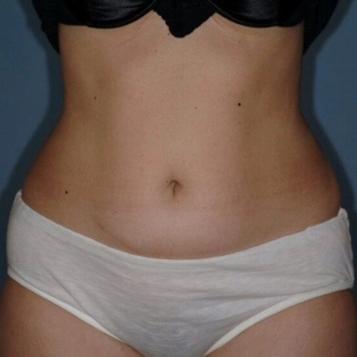 InMode BodyFX Before 2
