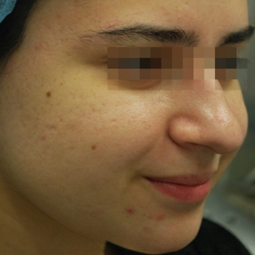 InMode Fractora after 1