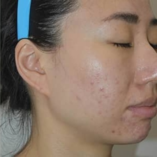 Lumi photo Facial Before 1