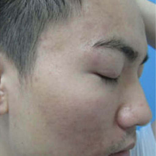 Lumi photo Facial After 1