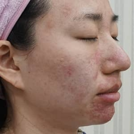Lumi photo Facial Before 1