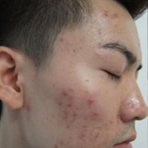Lumi photo Facial After 1