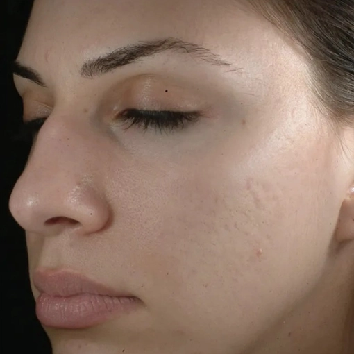 Microdermabrasion Before 3