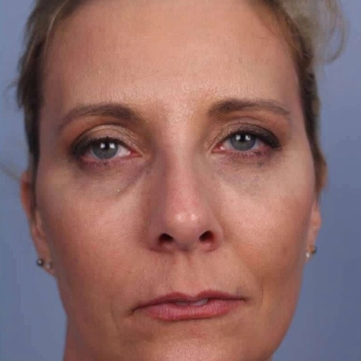 Microdermabrasion Before 3
