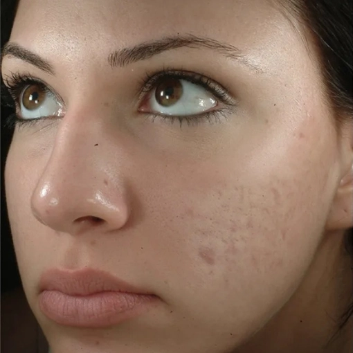 Microdermabrasion Before 3