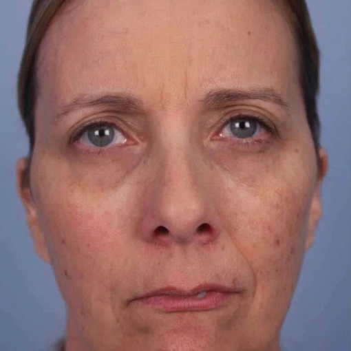 Microdermabrasion Before 3