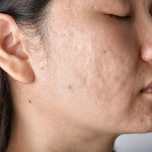 Microdermabrasion Before 3