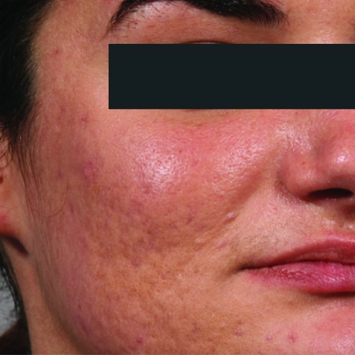 Microneedling After 1