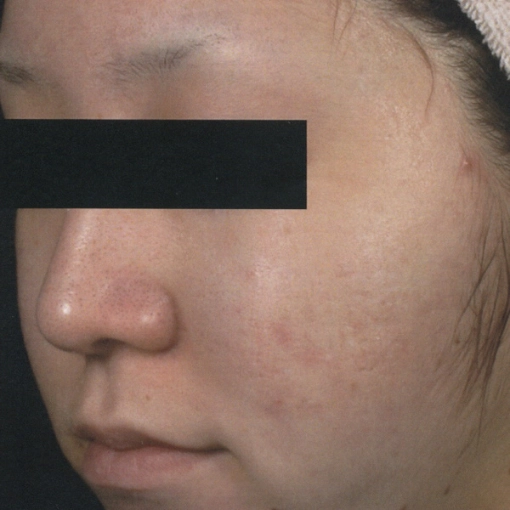 Microneedling After 2