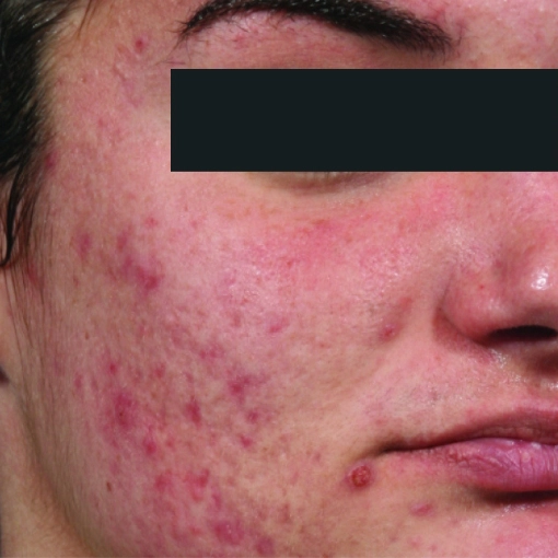 Microneedling Before 1