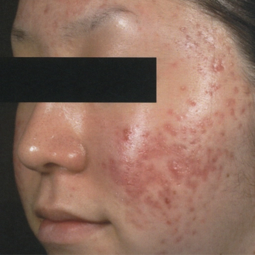 Microneedling Before 2