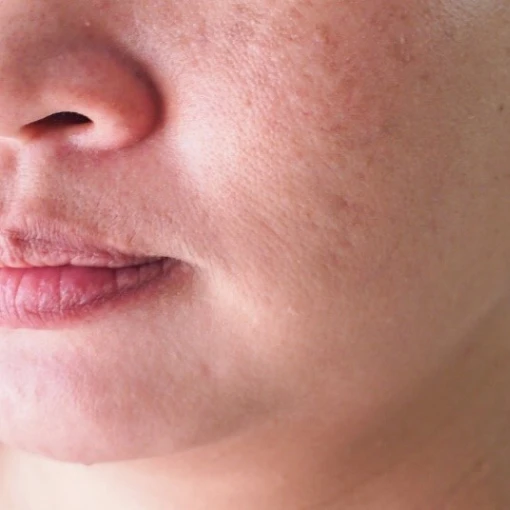 Nordlys Ellipse® IPL before 4