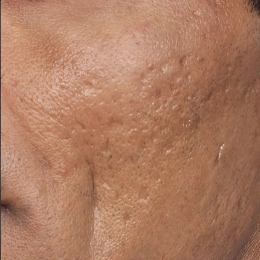 Picosure after 5